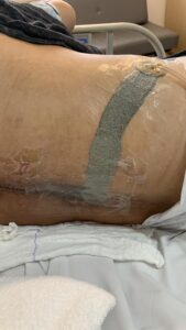 TPN em ponte